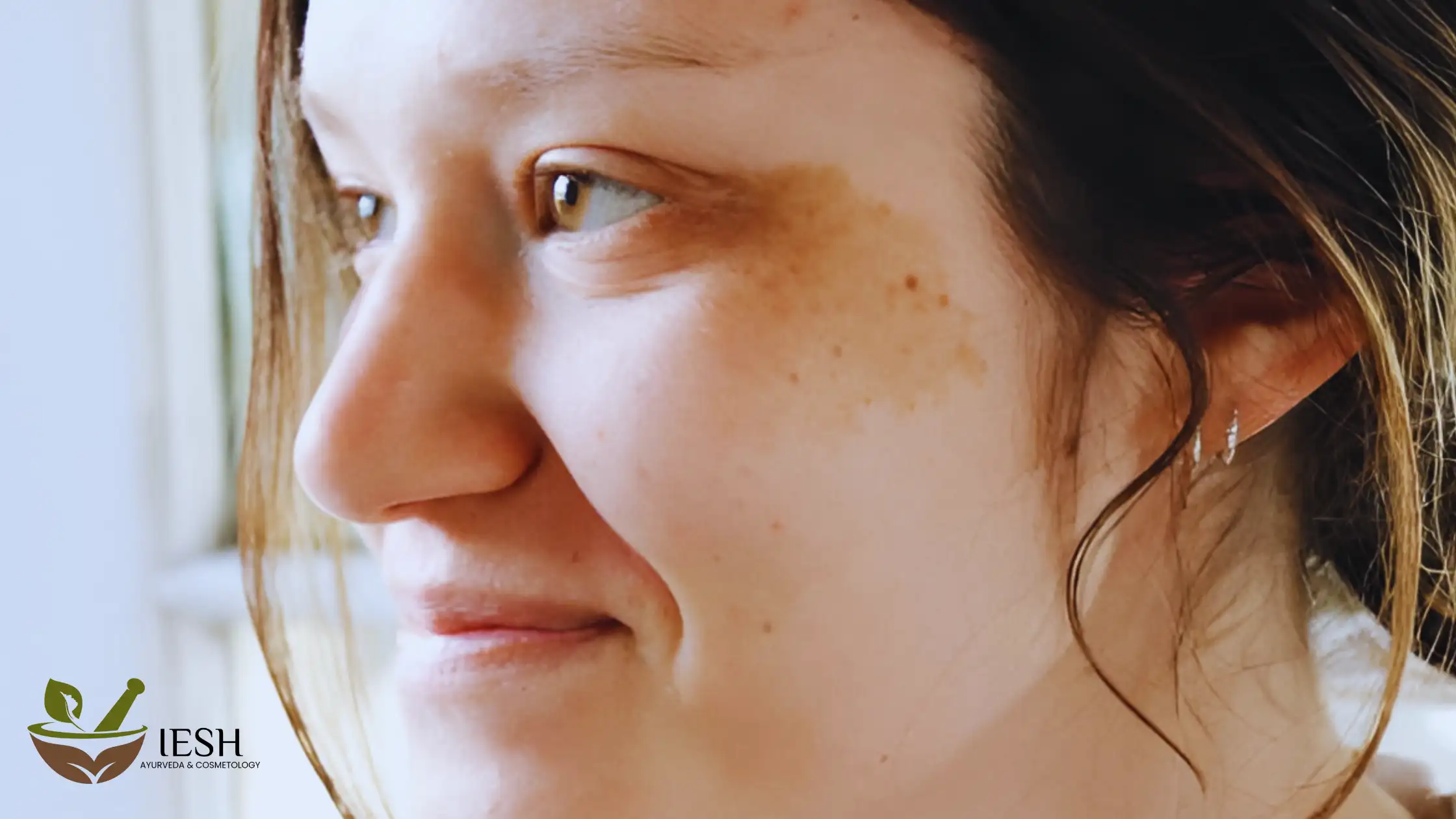 Best Treatments For Pigmentation