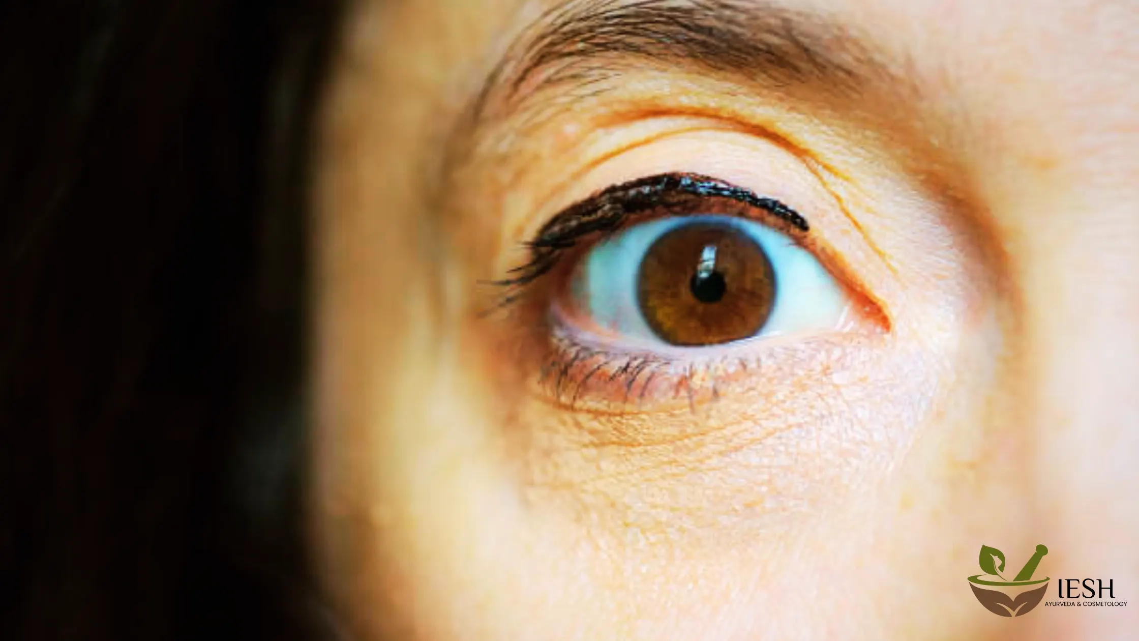 Get Rid of Fine Lines & Wrinkles
