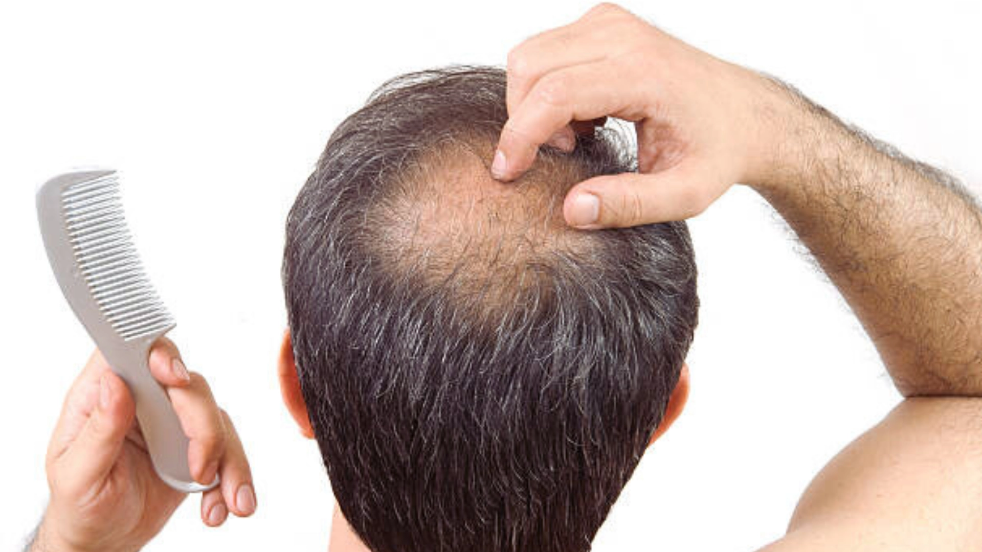 Prevent Crown Hair Loss