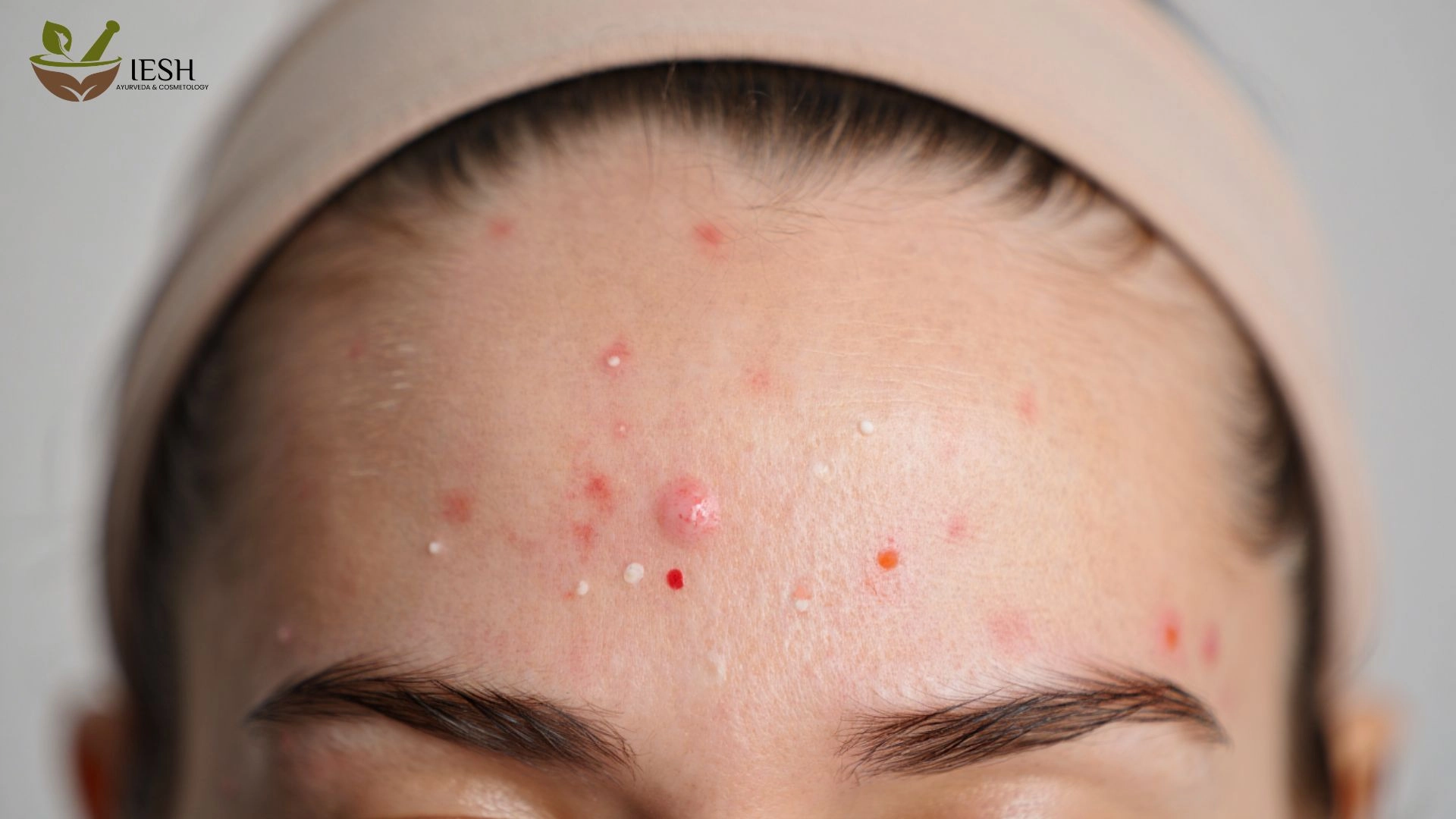 How to Avoid Pimples on Forehead