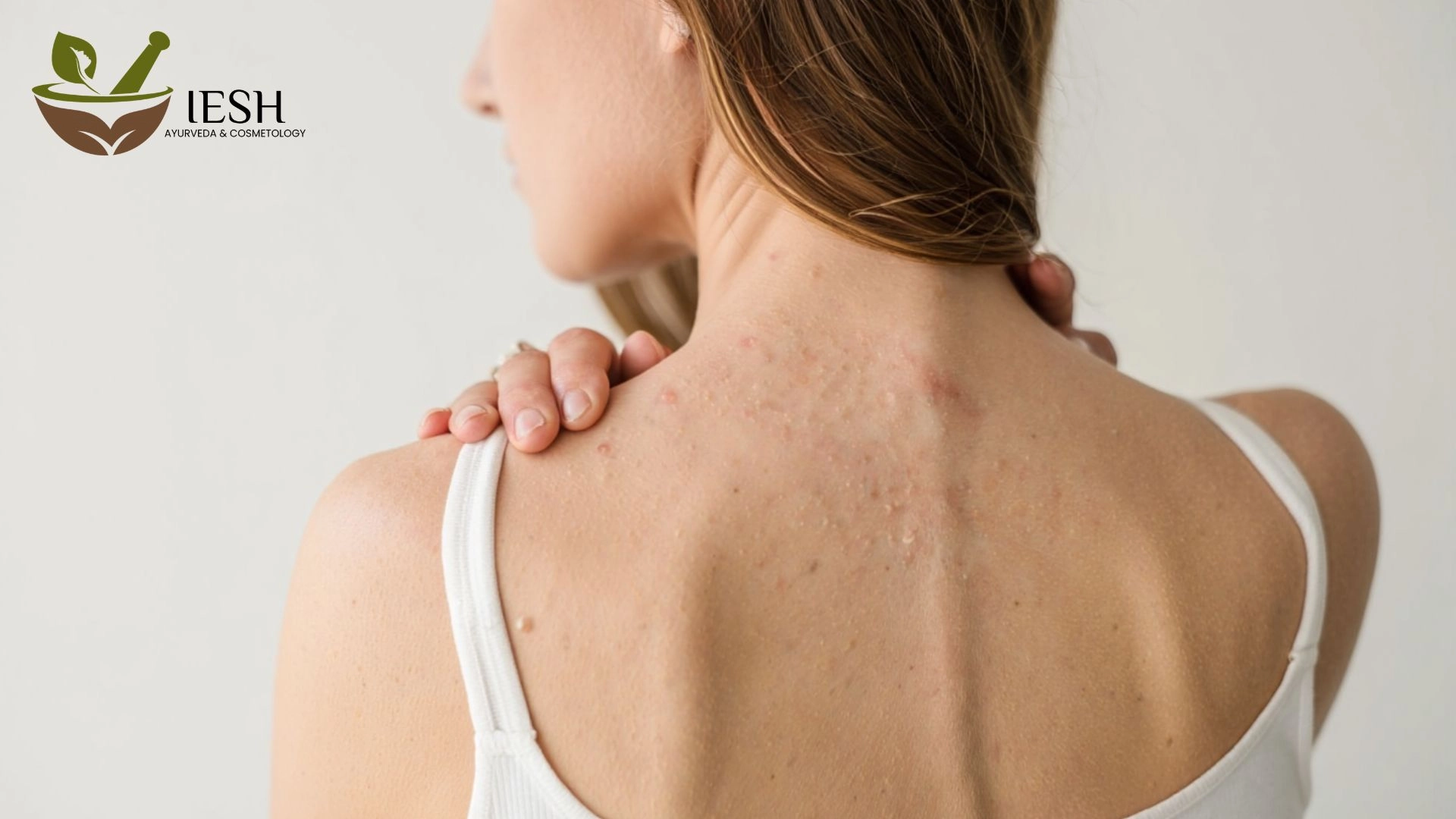 What Causes Back Acne in Females